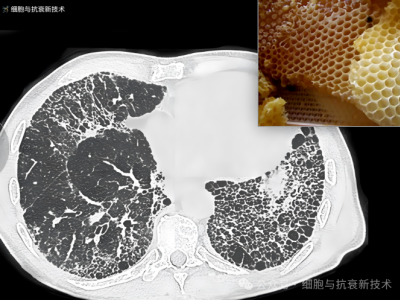 外泌體霧化可治療肺部結節(jié)及肺纖維化