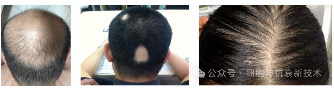 干細胞外泌體在生發(fā)領(lǐng)域的應(yīng)用